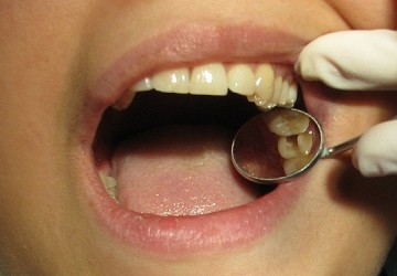 مراقبت های پس از درمان ریشه